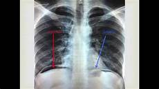 Diaphragms