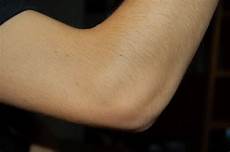 Elbow