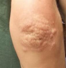 Elbows