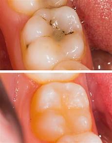 Sealants