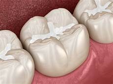 Sealants